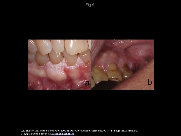 Fig.  9 Oral Surgery, Oral Medicine, Oral Pathology and Oral Radiology 2018 125591 -602