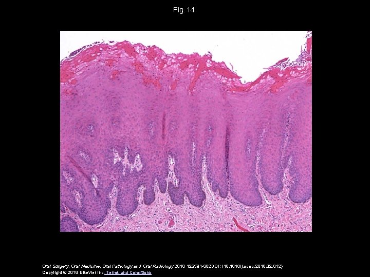 Fig.  14 Oral Surgery, Oral Medicine, Oral Pathology and Oral Radiology 2018 125591 -602