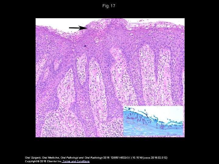 Fig.  17 Oral Surgery, Oral Medicine, Oral Pathology and Oral Radiology 2018 125591 -602