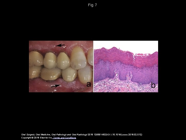 Fig.  7 Oral Surgery, Oral Medicine, Oral Pathology and Oral Radiology 2018 125591 -602