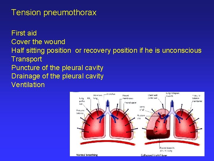 Tension pneumothorax First aid Cover the wound Half sitting position or recovery position if
