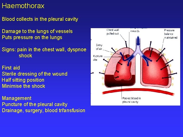 Haemothorax Blood collects in the pleural cavity Damage to the lungs of vessels Puts