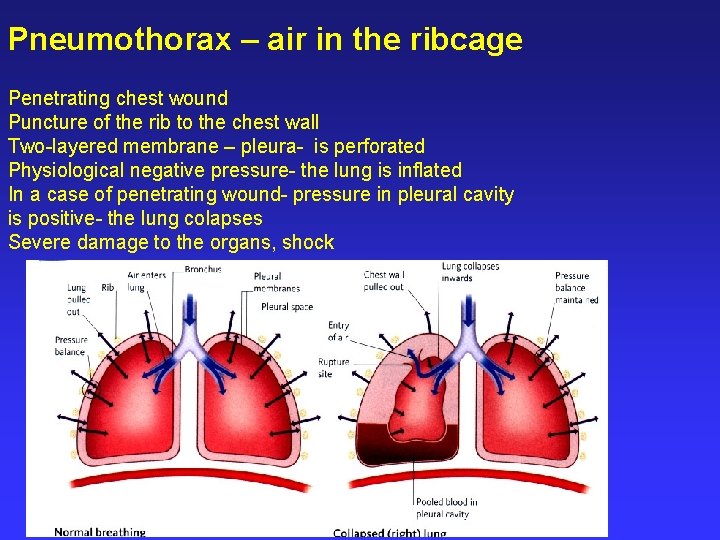 Pneumothorax – air in the ribcage Penetrating chest wound Puncture of the rib to