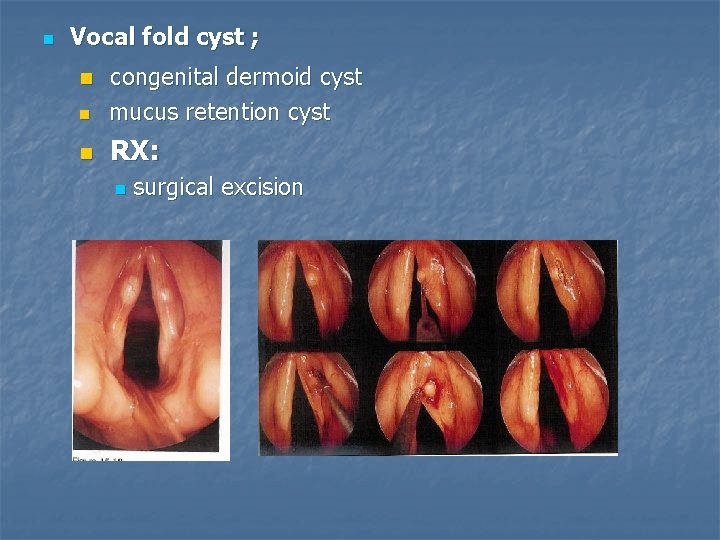 n Vocal fold cyst ; n congenital dermoid cyst mucus retention cyst n RX: