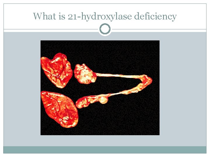 What is 21 -hydroxylase deficiency 