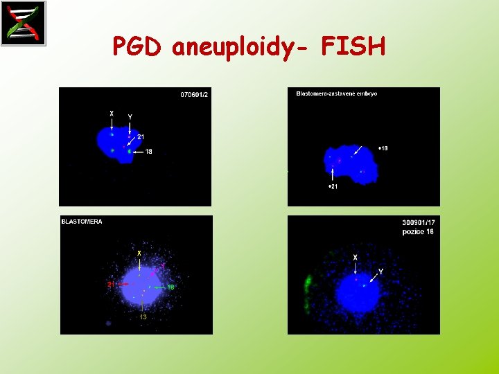 PGD aneuploidy- FISH 
