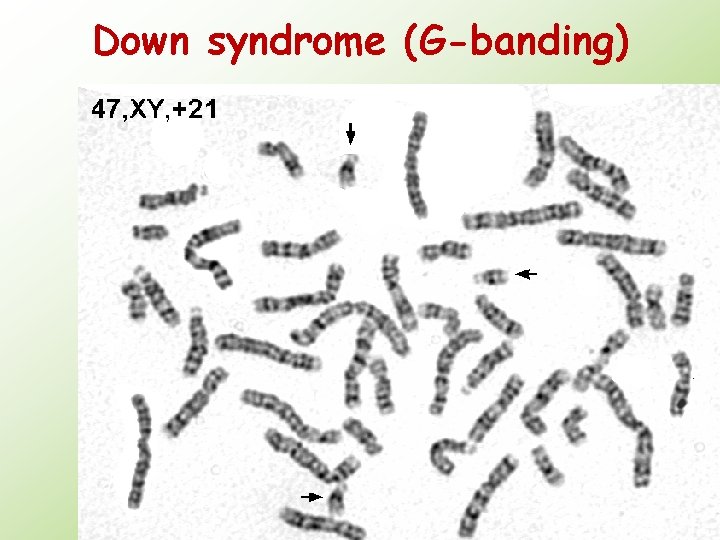 Down syndrome (G-banding) 