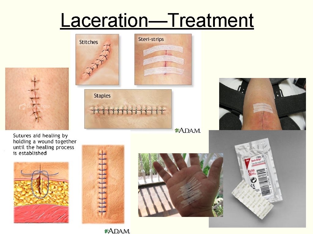 Laceration—Treatment 