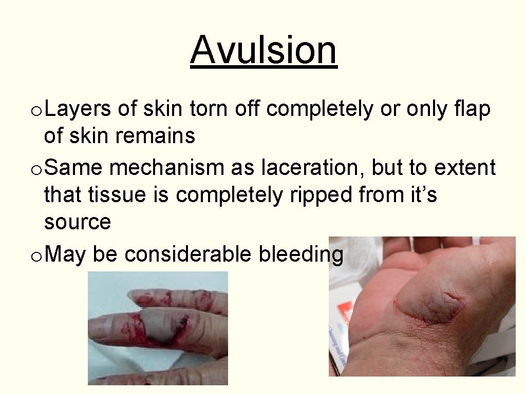 Avulsion o. Layers of skin torn off completely or only flap of skin remains