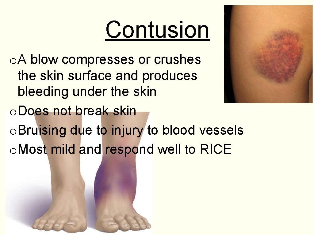 Contusion o. A blow compresses or crushes the skin surface and produces bleeding under
