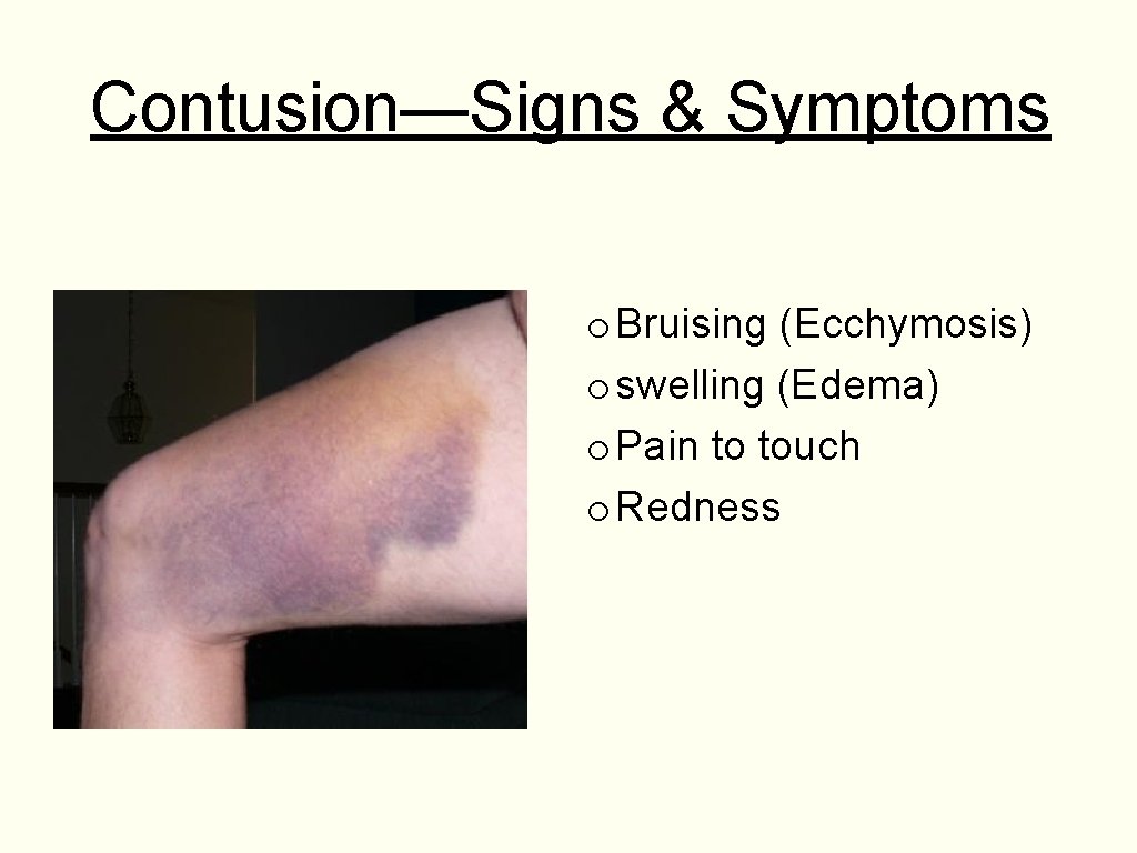 Contusion—Signs & Symptoms o Bruising (Ecchymosis) o swelling (Edema) o Pain to touch o