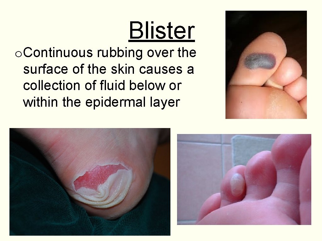 Blister o. Continuous rubbing over the surface of the skin causes a collection of