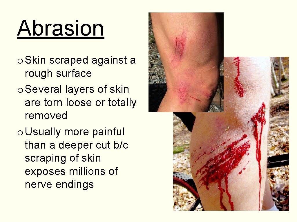 Abrasion o Skin scraped against a rough surface o Several layers of skin are