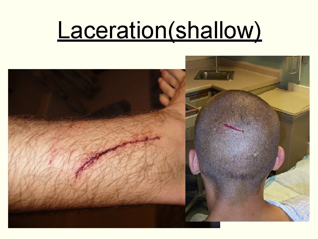 Laceration(shallow) 