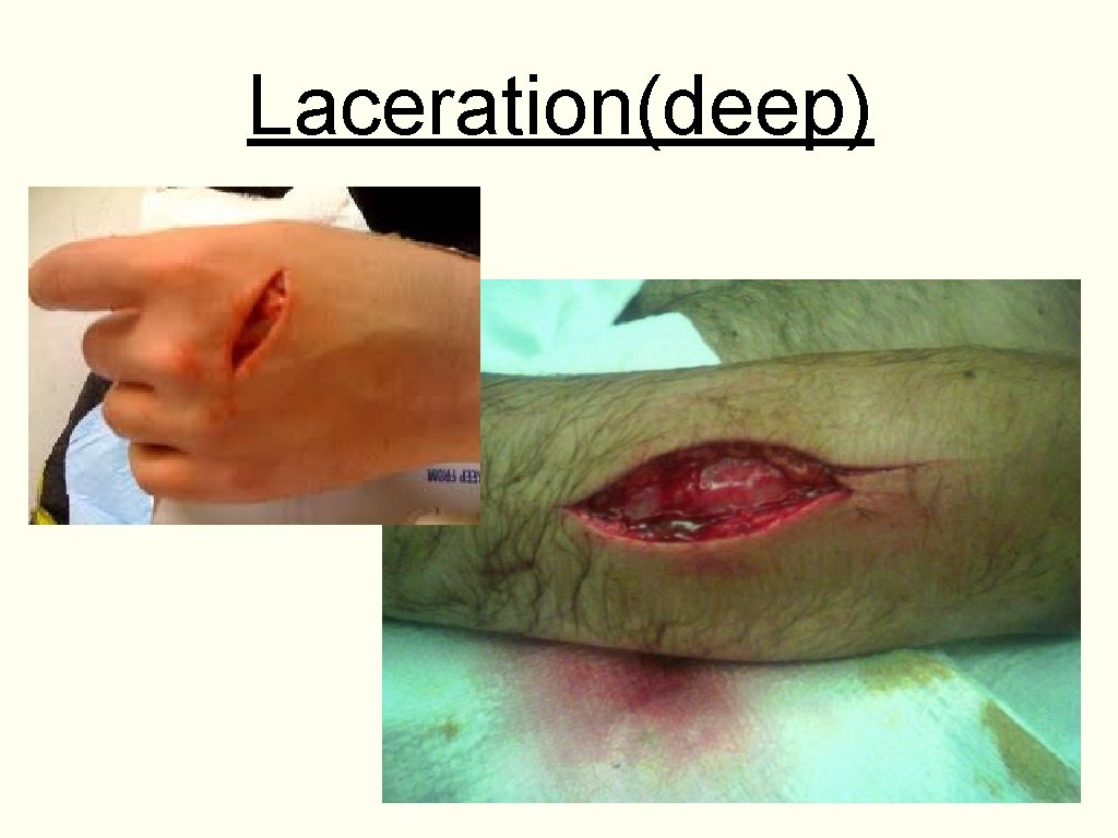 Laceration(deep) 