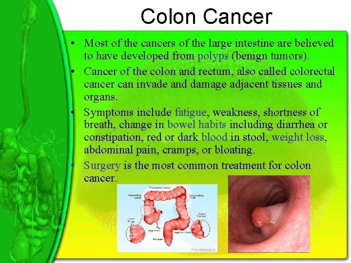 Colon Cancer • Most of the cancers of the large intestine are believed to