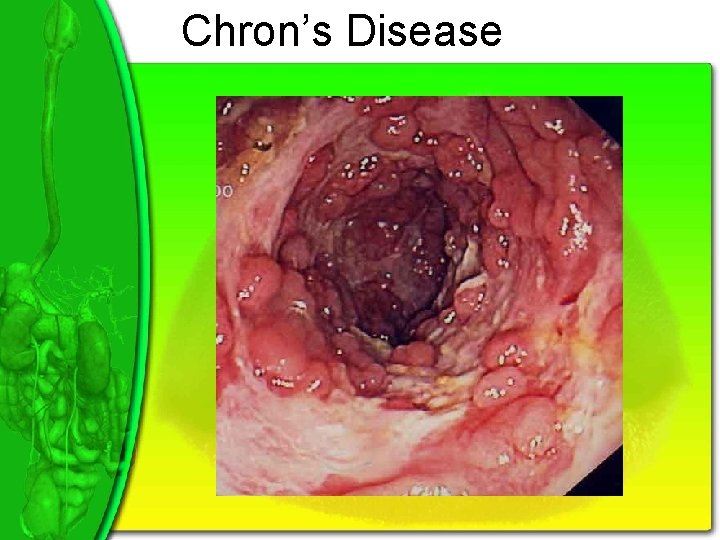 Chron’s Disease 