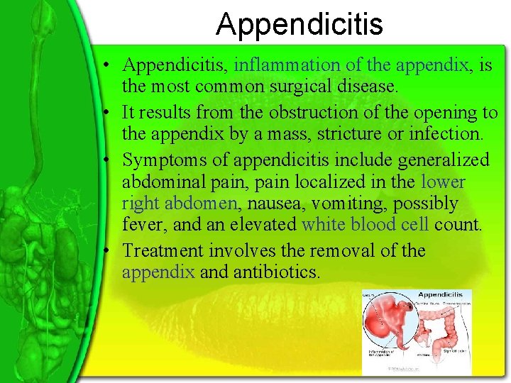 Appendicitis • Appendicitis, inflammation of the appendix, is the most common surgical disease. •