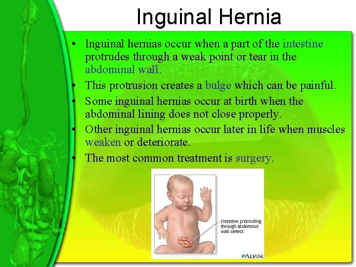 Inguinal Hernia • Inguinal hernias occur when a part of the intestine protrudes through