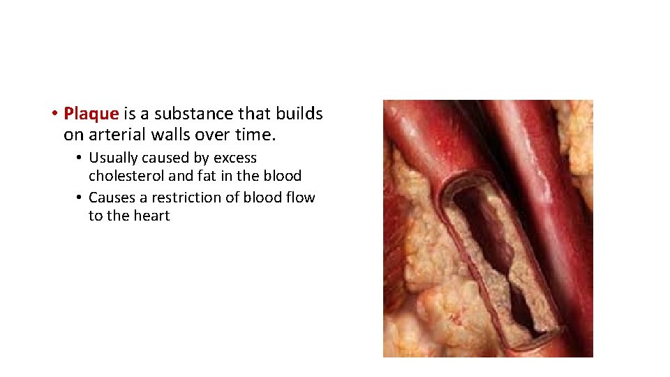  • Plaque is a substance that builds on arterial walls over time. •