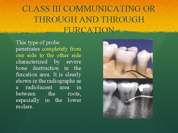 CLASS III COMMUNICATING OR THROUGH AND THROUGH FURCATION This type of probe penetrates completely