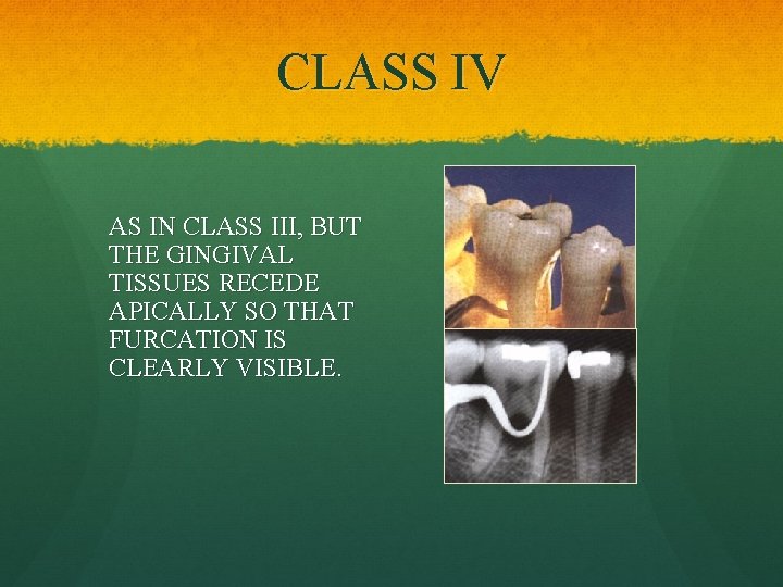 CLASS IV AS IN CLASS III, BUT THE GINGIVAL TISSUES RECEDE APICALLY SO THAT