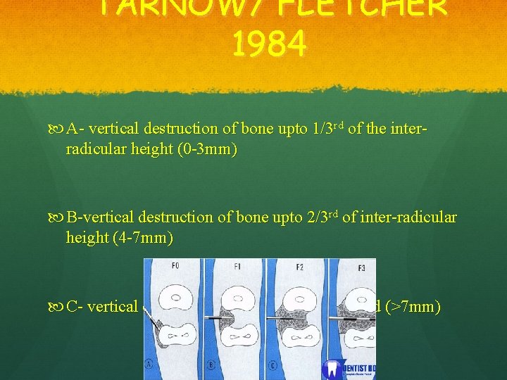 TARNOW/ FLETCHER 1984 A- vertical destruction of bone upto 1/3 rd of the interradicular