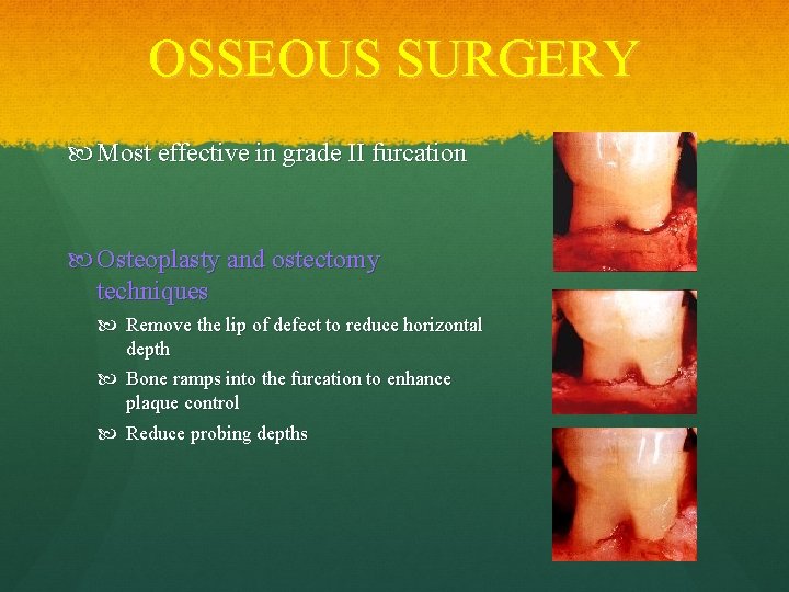 OSSEOUS SURGERY Most effective in grade II furcation Osteoplasty and ostectomy techniques Remove the