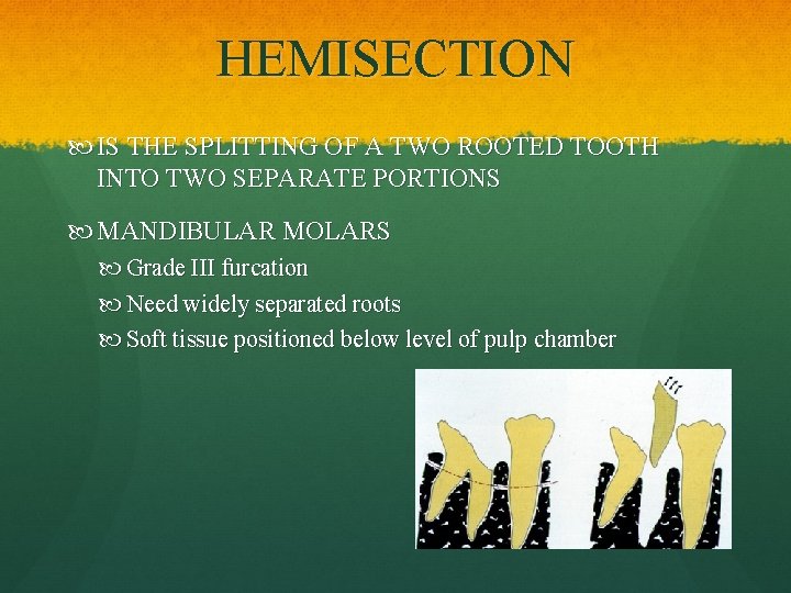 HEMISECTION IS THE SPLITTING OF A TWO ROOTED TOOTH INTO TWO SEPARATE PORTIONS MANDIBULAR