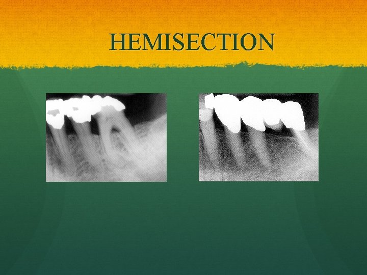 HEMISECTION 