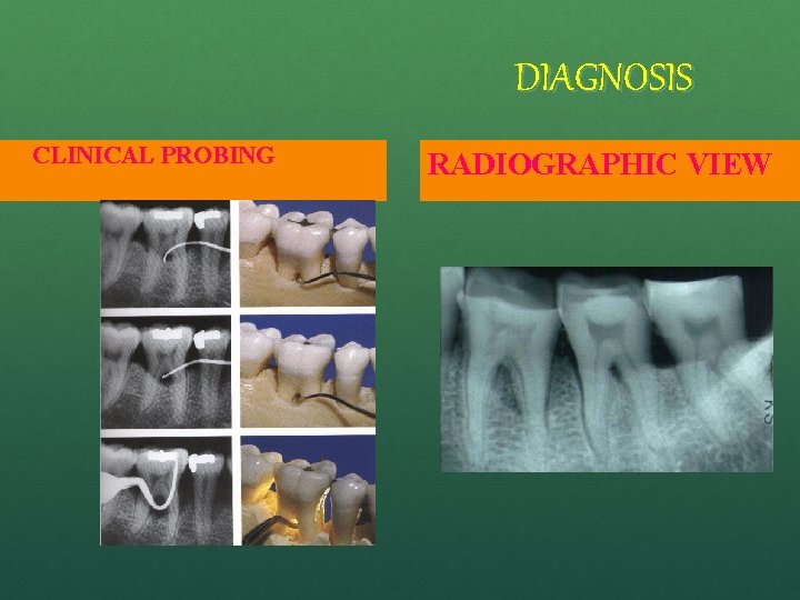 DIAGNOSIS CLINICAL PROBING RADIOGRAPHIC VIEW 