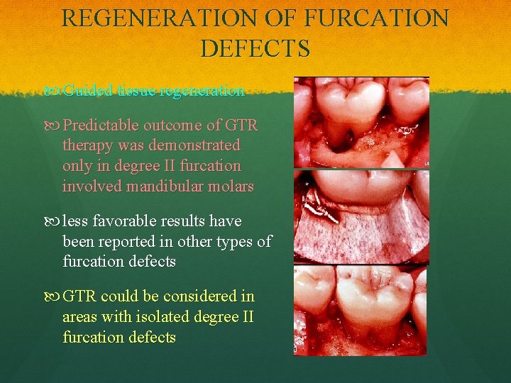 REGENERATION OF FURCATION DEFECTS Guided tissue regeneration Predictable outcome of GTR therapy was demonstrated