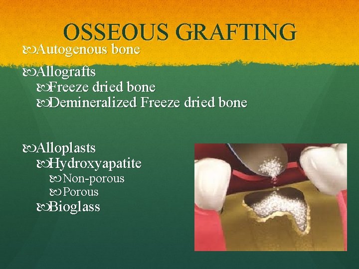 OSSEOUS GRAFTING Autogenous bone Allografts Freeze dried bone Demineralized Freeze dried bone Alloplasts Hydroxyapatite