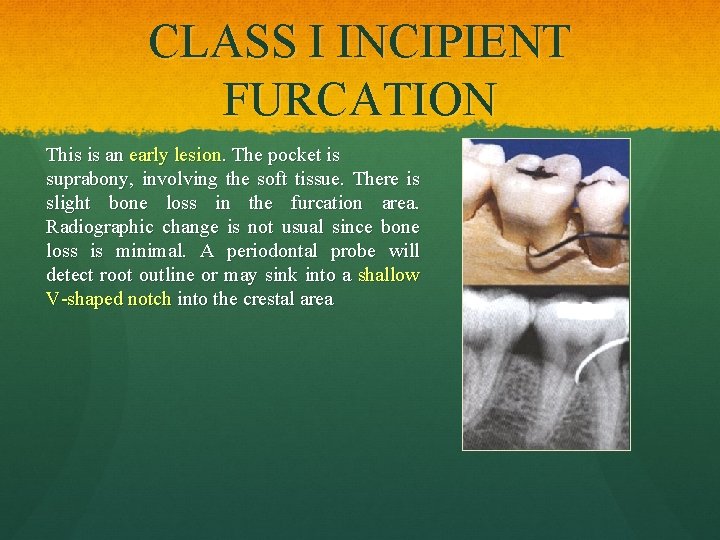 CLASS I INCIPIENT FURCATION This is an early lesion. The pocket is suprabony, involving