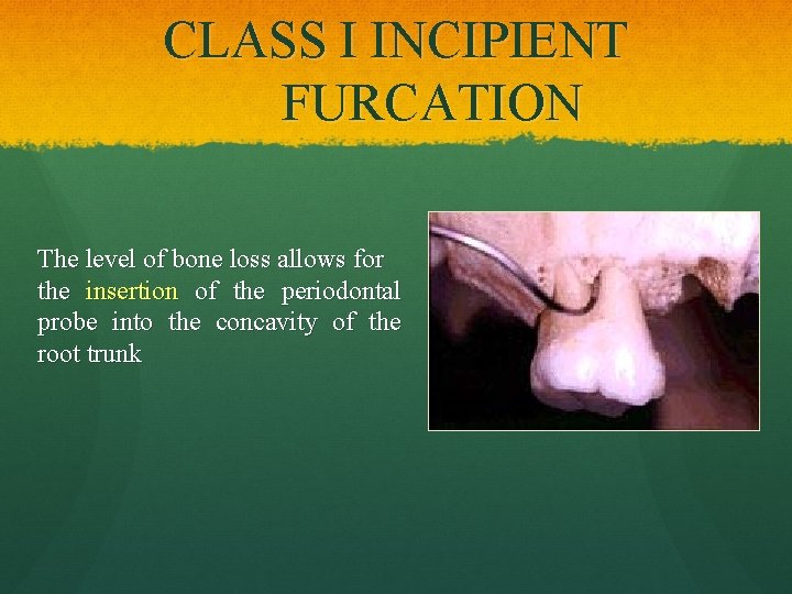 CLASS I INCIPIENT FURCATION The level of bone loss allows for the insertion of