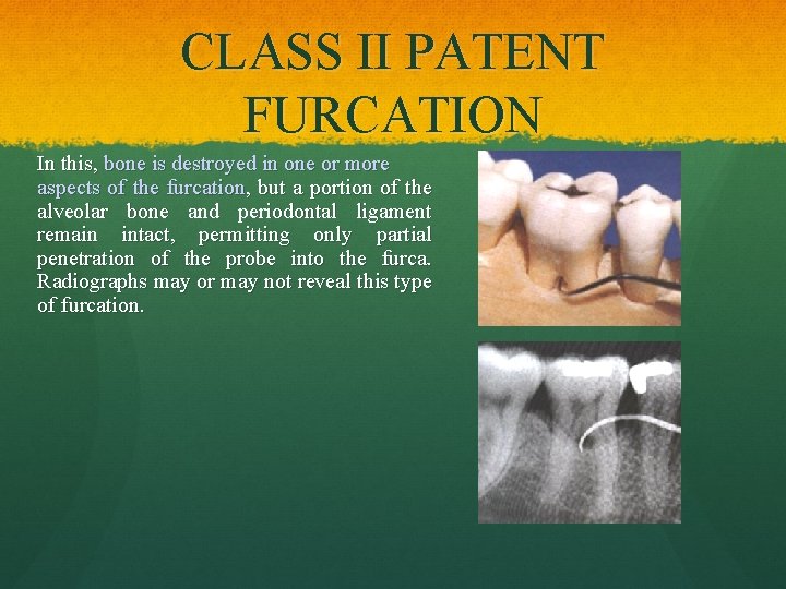 CLASS II PATENT FURCATION In this, bone is destroyed in one or more aspects