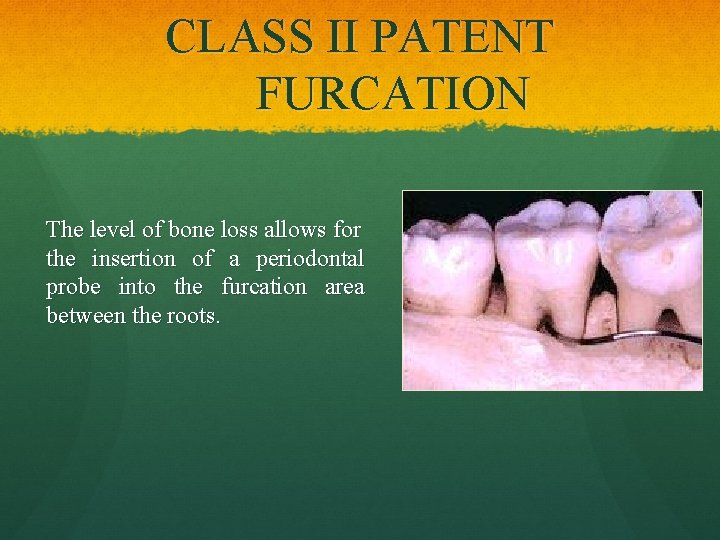 CLASS II PATENT FURCATION The level of bone loss allows for the insertion of