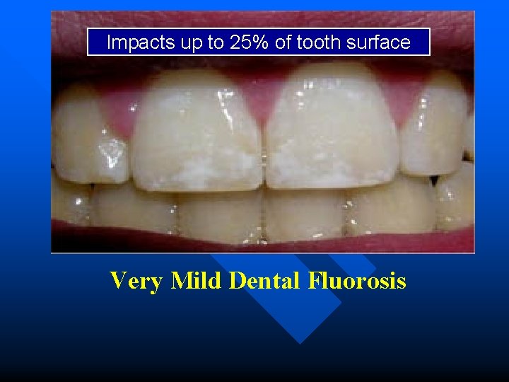 Impacts up to 25% of tooth surface Very Mild Dental Fluorosis 