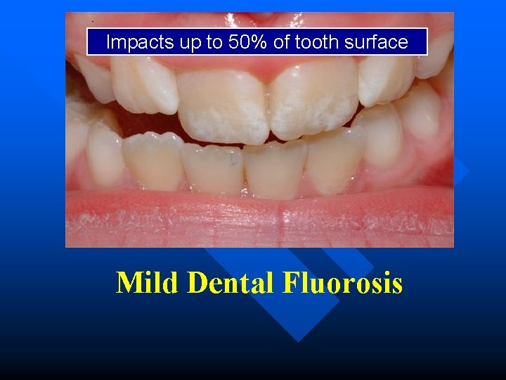 Impacts up to 50% of tooth surface Mild Dental Fluorosis 