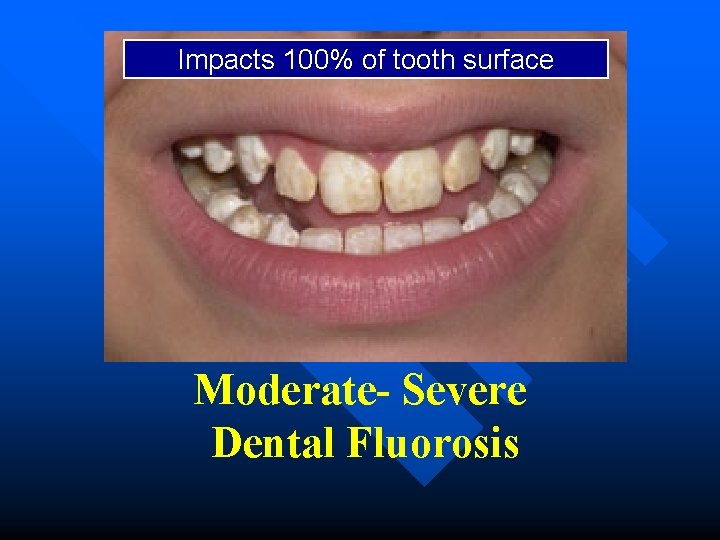 Impacts 100% of tooth surface Moderate- Severe Dental Fluorosis 