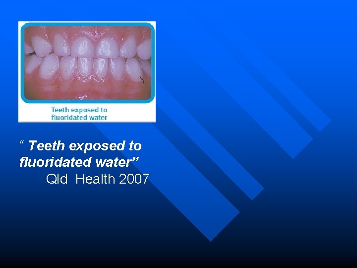 “ Teeth exposed to fluoridated water” Qld Health 2007 