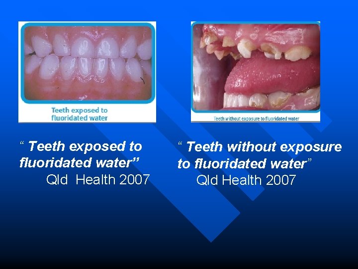 “ Teeth exposed to fluoridated water” Qld Health 2007 “ Teeth without exposure to