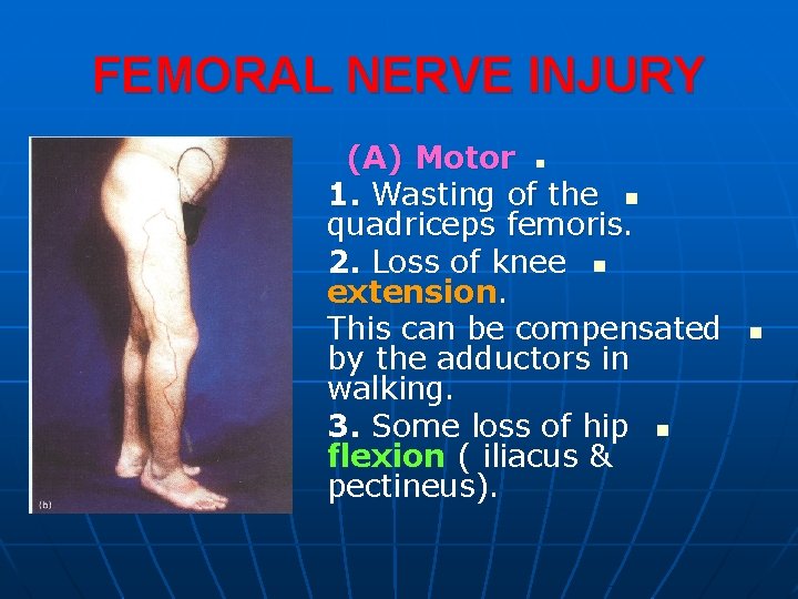 FEMORAL NERVE INJURY (A) Motor n 1. Wasting of the n quadriceps femoris. 2.