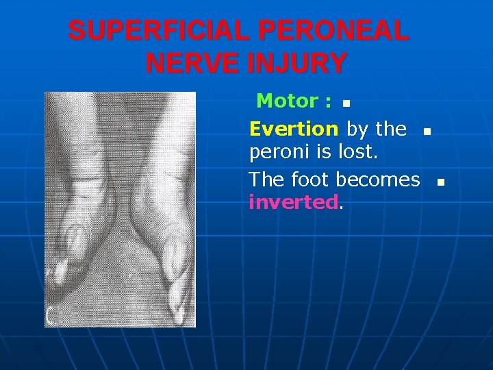 SUPERFICIAL PERONEAL NERVE INJURY Motor : n Evertion by the n peroni is lost.