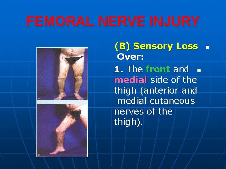 FEMORAL NERVE INJURY (B) Sensory Loss Over: 1. The front and n medial side