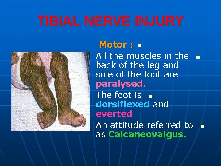 TIBIAL NERVE INJURY Motor : n All the muscles in the back of the