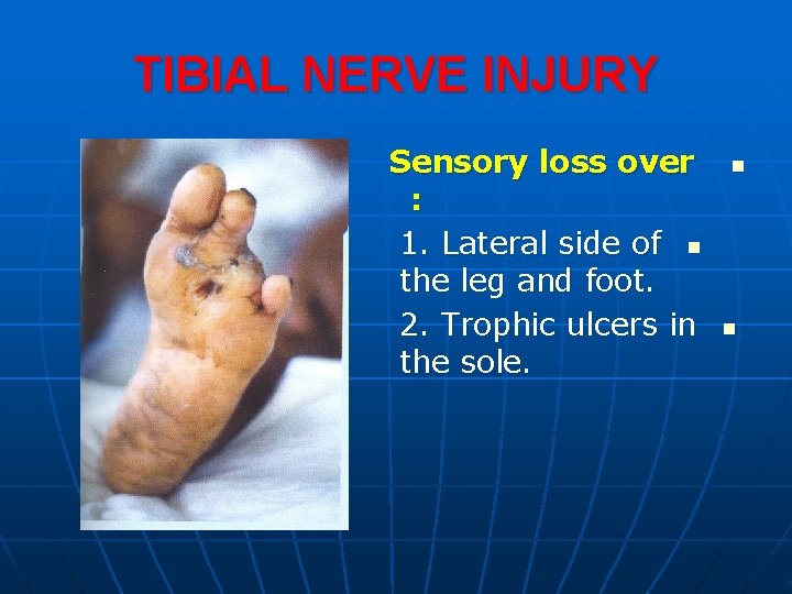 TIBIAL NERVE INJURY Sensory loss over : 1. Lateral side of n the leg