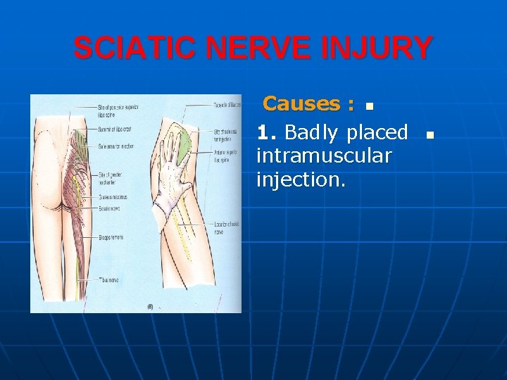 SCIATIC NERVE INJURY Causes : n 1. Badly placed intramuscular injection. n 