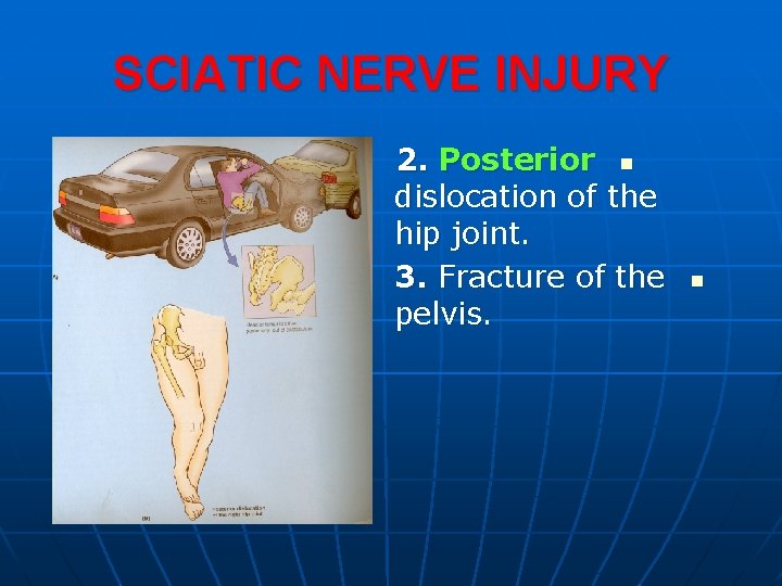 SCIATIC NERVE INJURY 2. Posterior n dislocation of the hip joint. 3. Fracture of