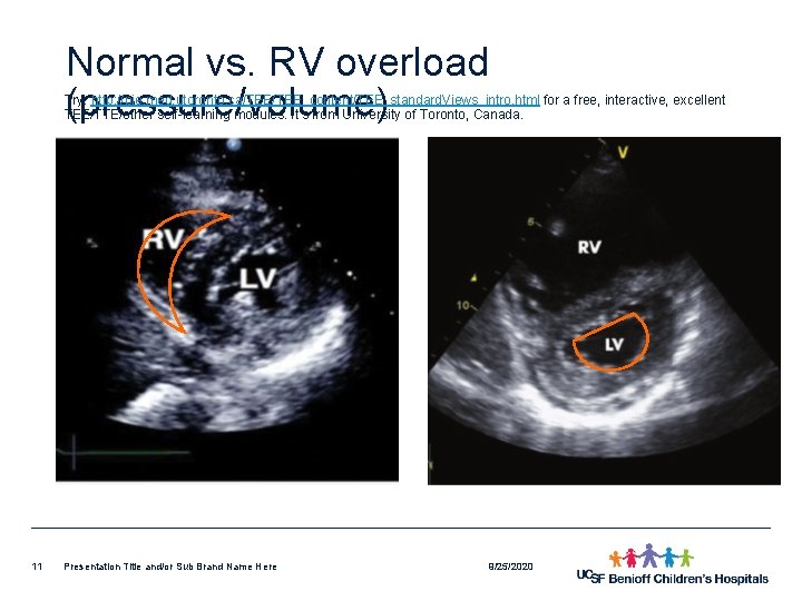 Normal vs. RV overload (pressure/volume) Try: http: //pie. med. utoronto. ca/TEE_content/TEE_standard. Views_intro. html for